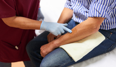 Pflegerin reibt den Unterarm eines Patienten mit kühlendem Gel ein.